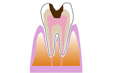 虫歯が歯髄まで進行した状態