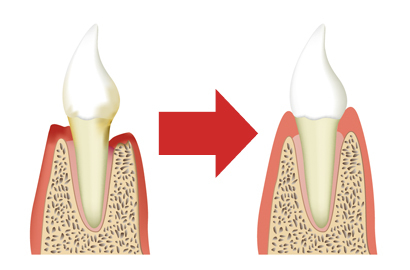 歯周組織再生術 