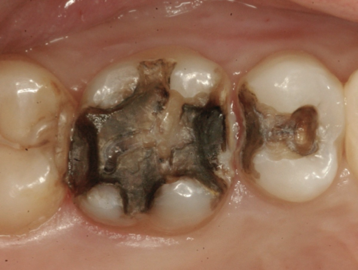 虫歯や金属の除去