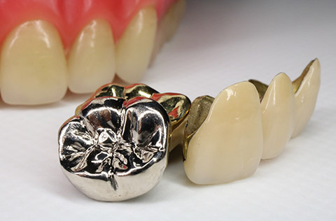 歯科で使用される金属とは